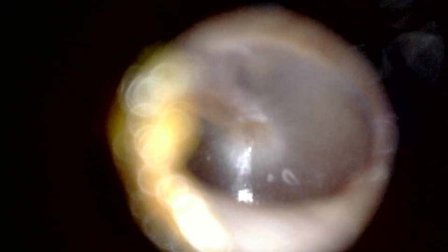 Second photo of ear canal showing eardrum taken with HearScope