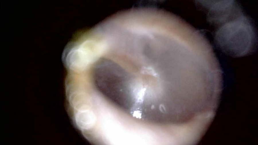 Ear canal with eardrum showing taken by HearScope